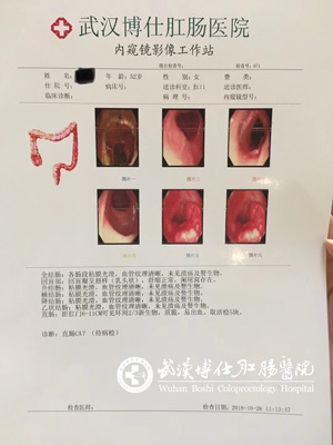 直肠肿瘤报告检查单